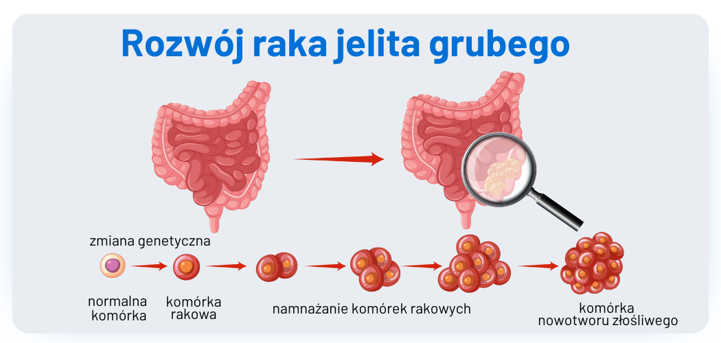 Rak jelita grubego rozwój